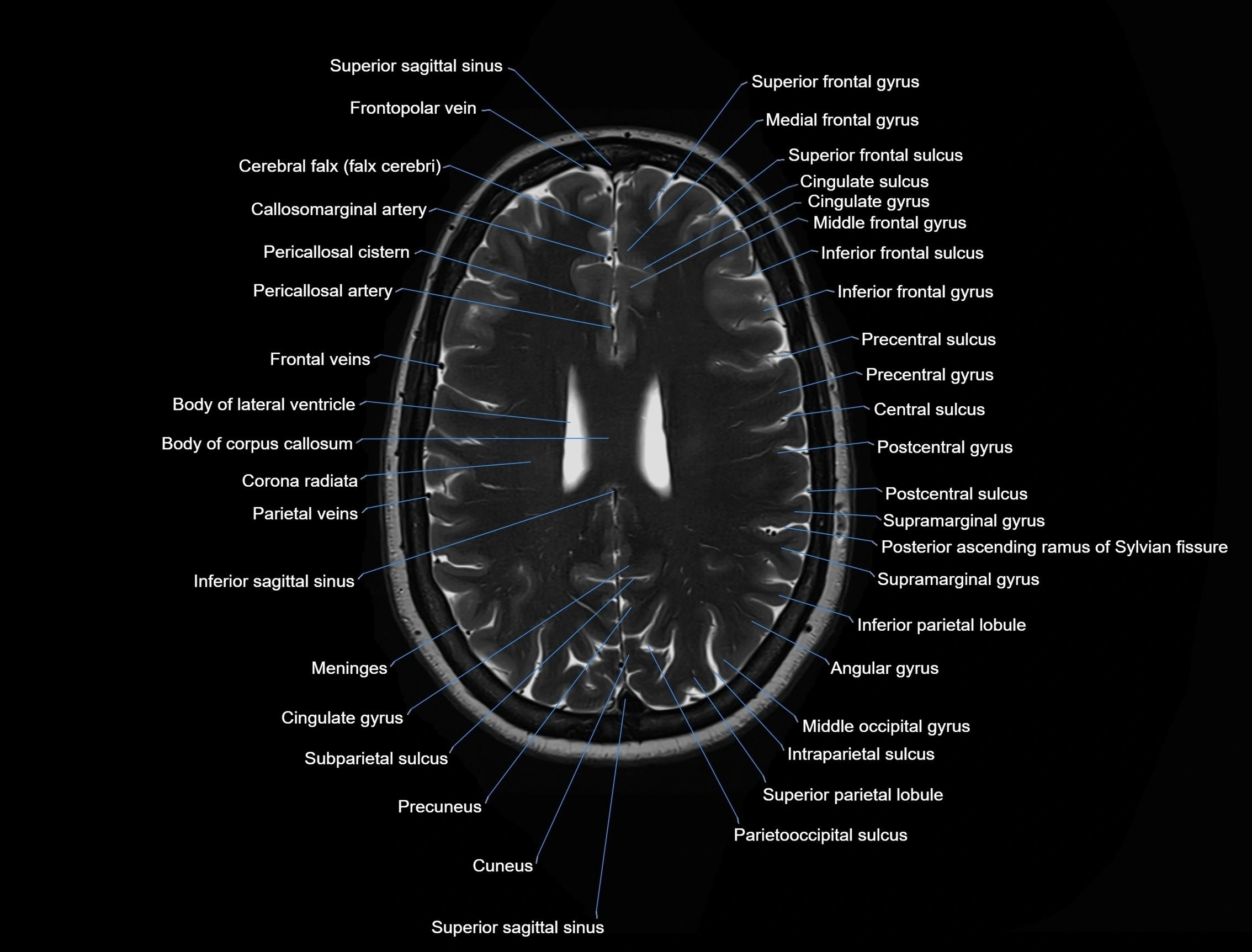 MRI Brain axial cross sectional radiology anatomy 3T image  -img-00001-00038.webp